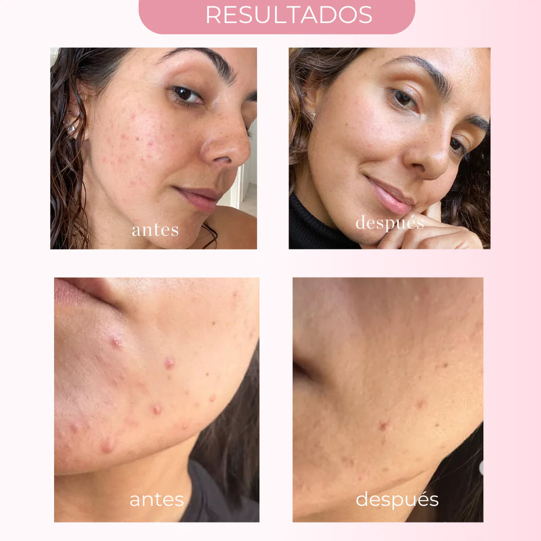 SOS SUSPENSIÓN SECANTE 0 ACNÉ